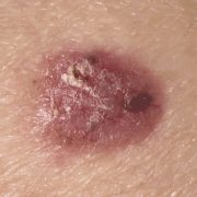 basal_cell_carcinoma_b_high